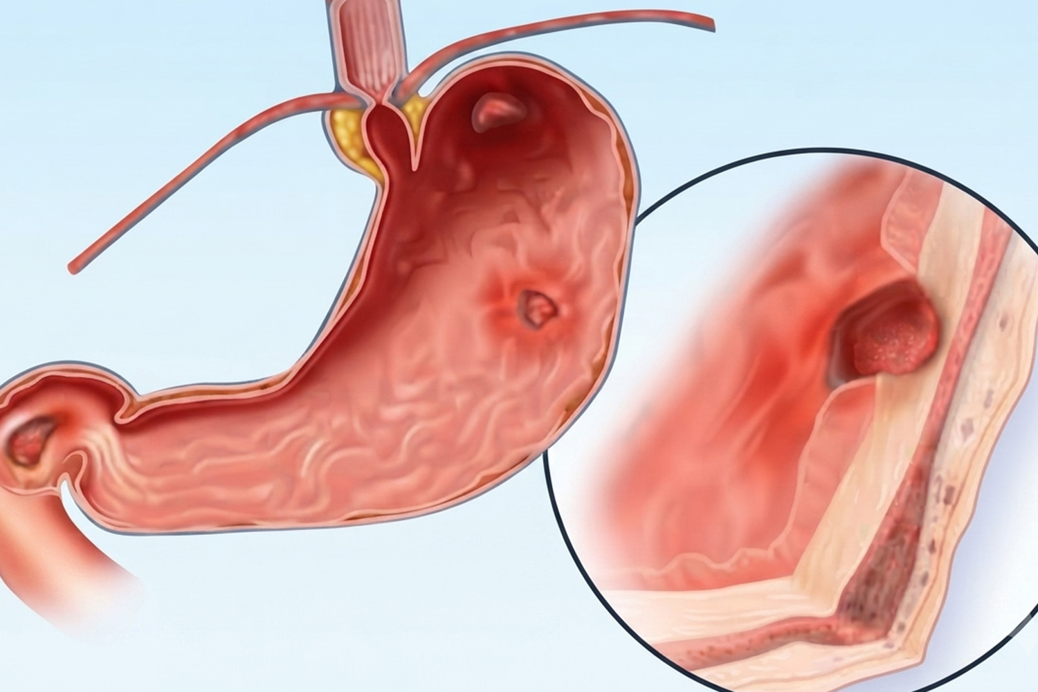 GI Bleeding Blood in Vomit - Stools
