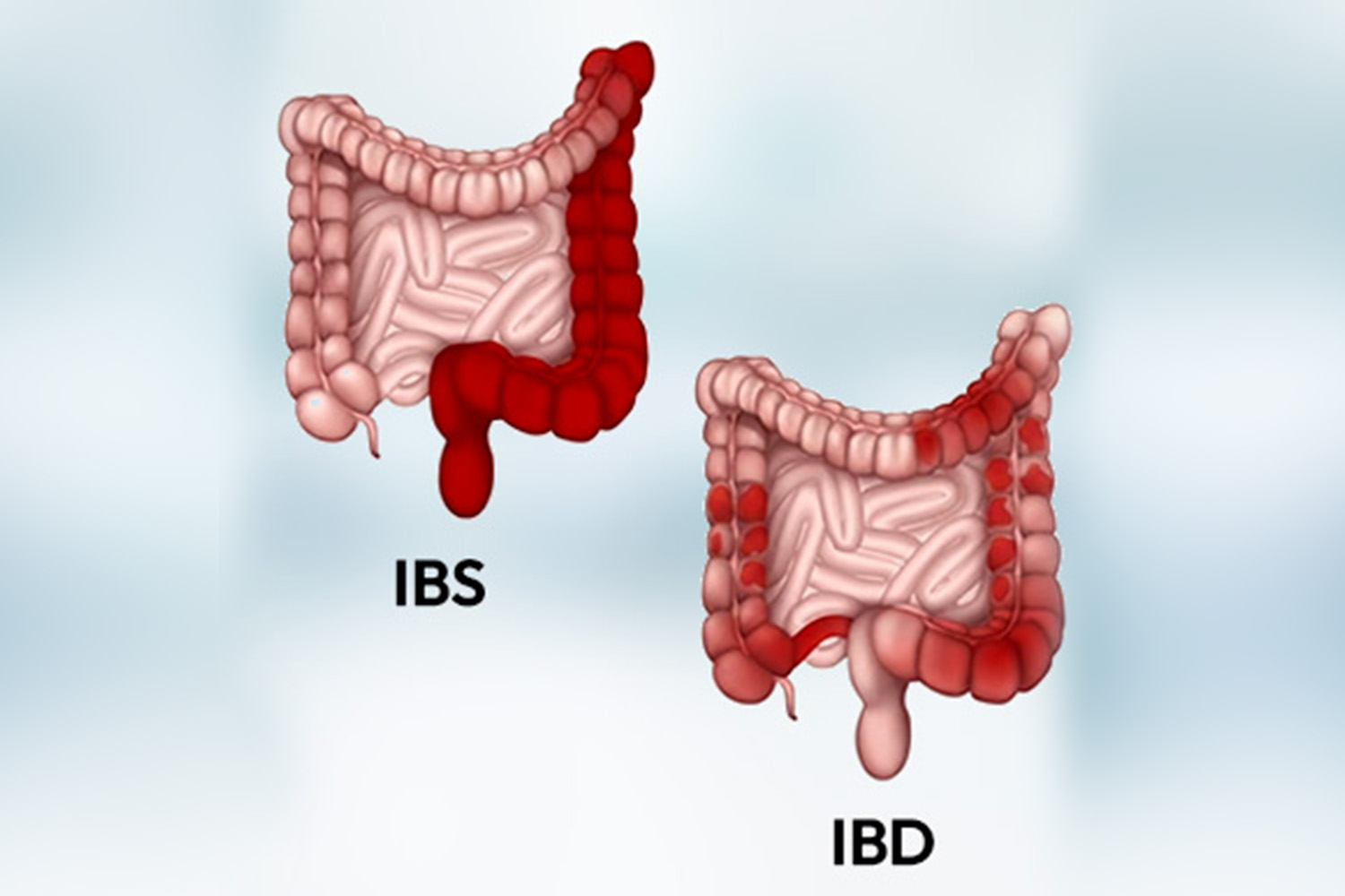 Irritable Bowel Syndrome (IBS) & IBD