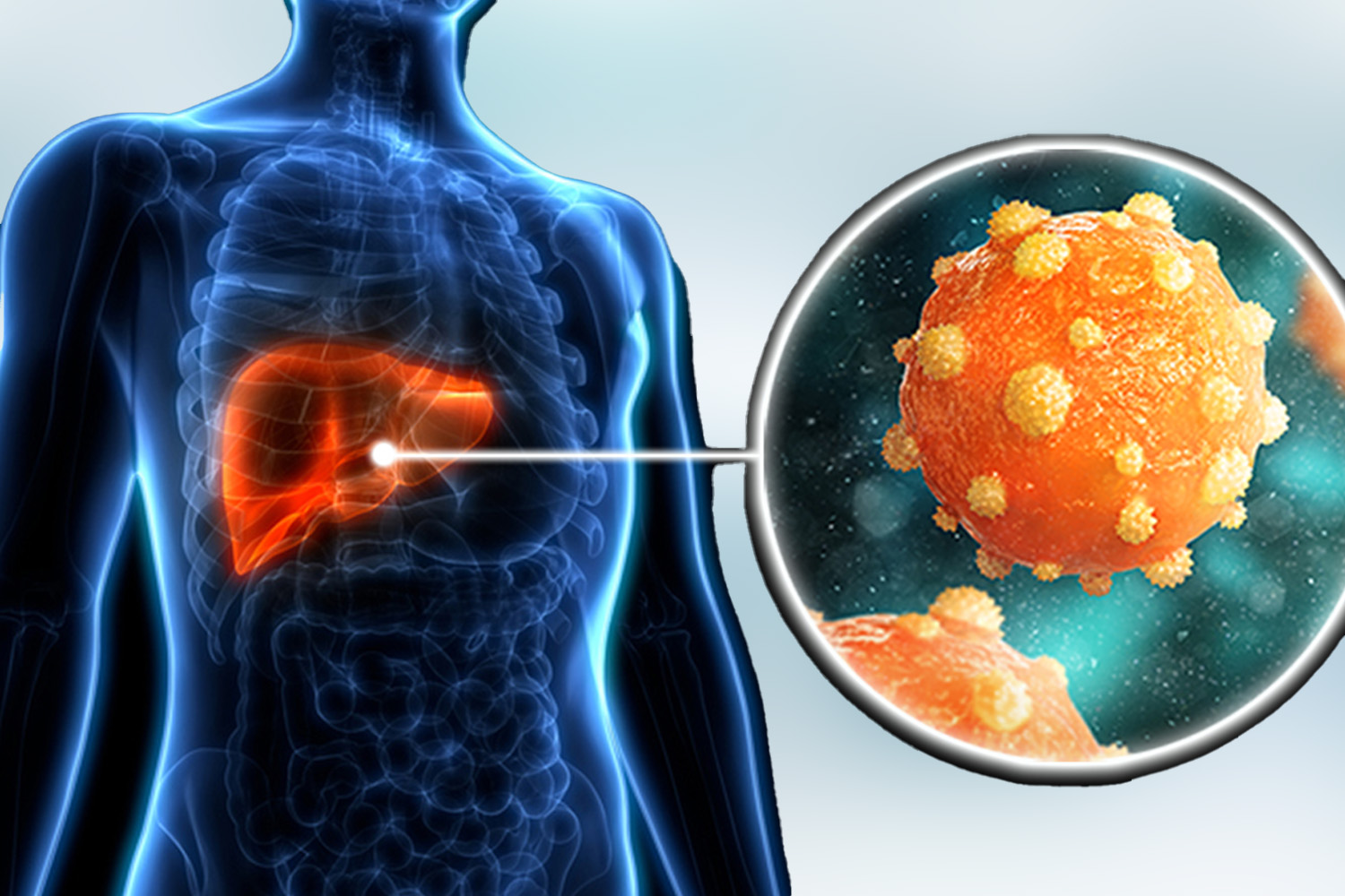 Viral Hepatitis (Hep B & C)